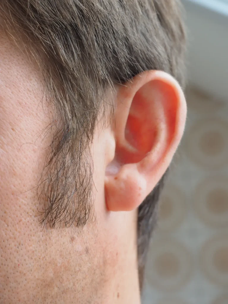 Hearing Loss